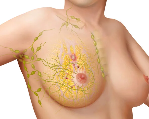 Lymphsystem und Lymphknoten bei Brustkrebs, © Frank Geisler, MediDesign Graphische Darstellung einer weiblichen Brust mit Lymphsystem und Lymphknoten
