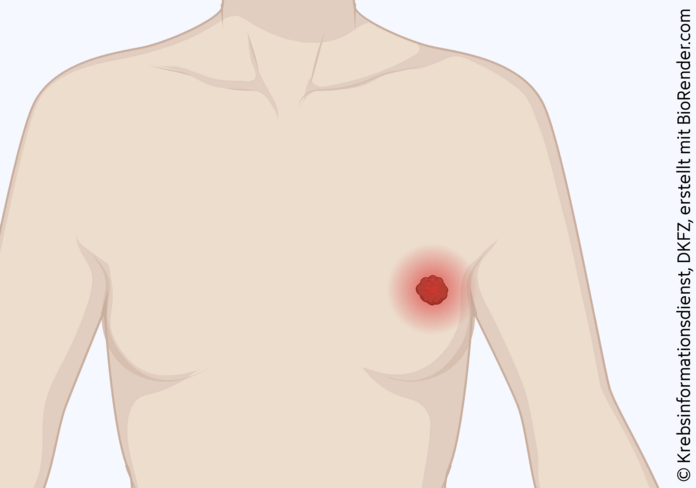 Brustkrebs, © Krebsinformationsdienst, DKFZ; erstellt mit Biorender.com Grafische Darstellung eines Tumor in der weiblichen Brust, der rot hinterlegt ist.