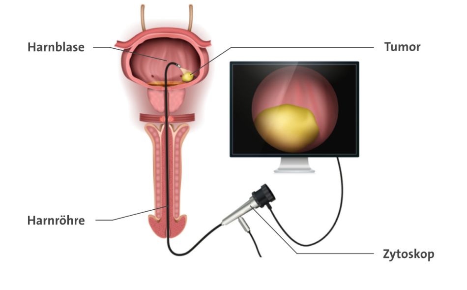 Anatomische Darstellung der Harnblase und Harnröhre beim Mann mit einem Untersuchungsgerät zur Blasenspiegelung (Zystoskop). Daneben ist ein vergrößerter Blasentumor auf einem Computer-Monitor dargestellt.