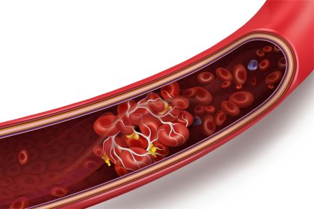Schematische Darstellung eines Blutgefäßes, das durch eine Thrombose verschlossen wird.