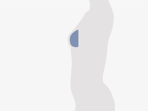 Grafische Darstellung eines weiblichen Oberkörpers, die Brust ist blau eingefärbt.