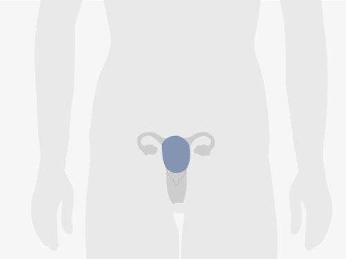Grafische Darstellung eines menschlichen Unterkörpers, blau eingefärbt ist der Gebärmutterkörper.