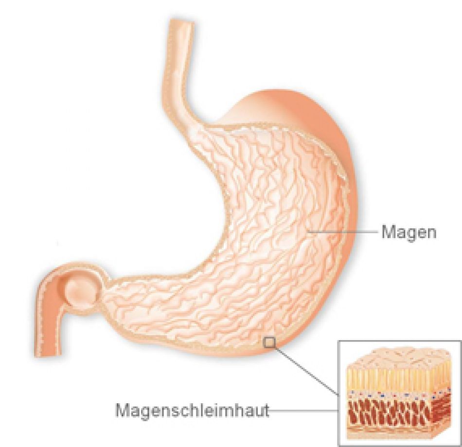 Eine anatomische Darstellung des Magens zeigt die Magenschleimhaut, aus der Magenkrebs hervorgehen kann.