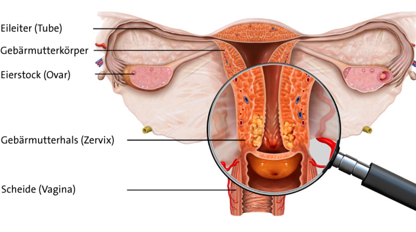 Bösartige Veränderung im Gebärmutterhals © MediDesign Frank Geisler