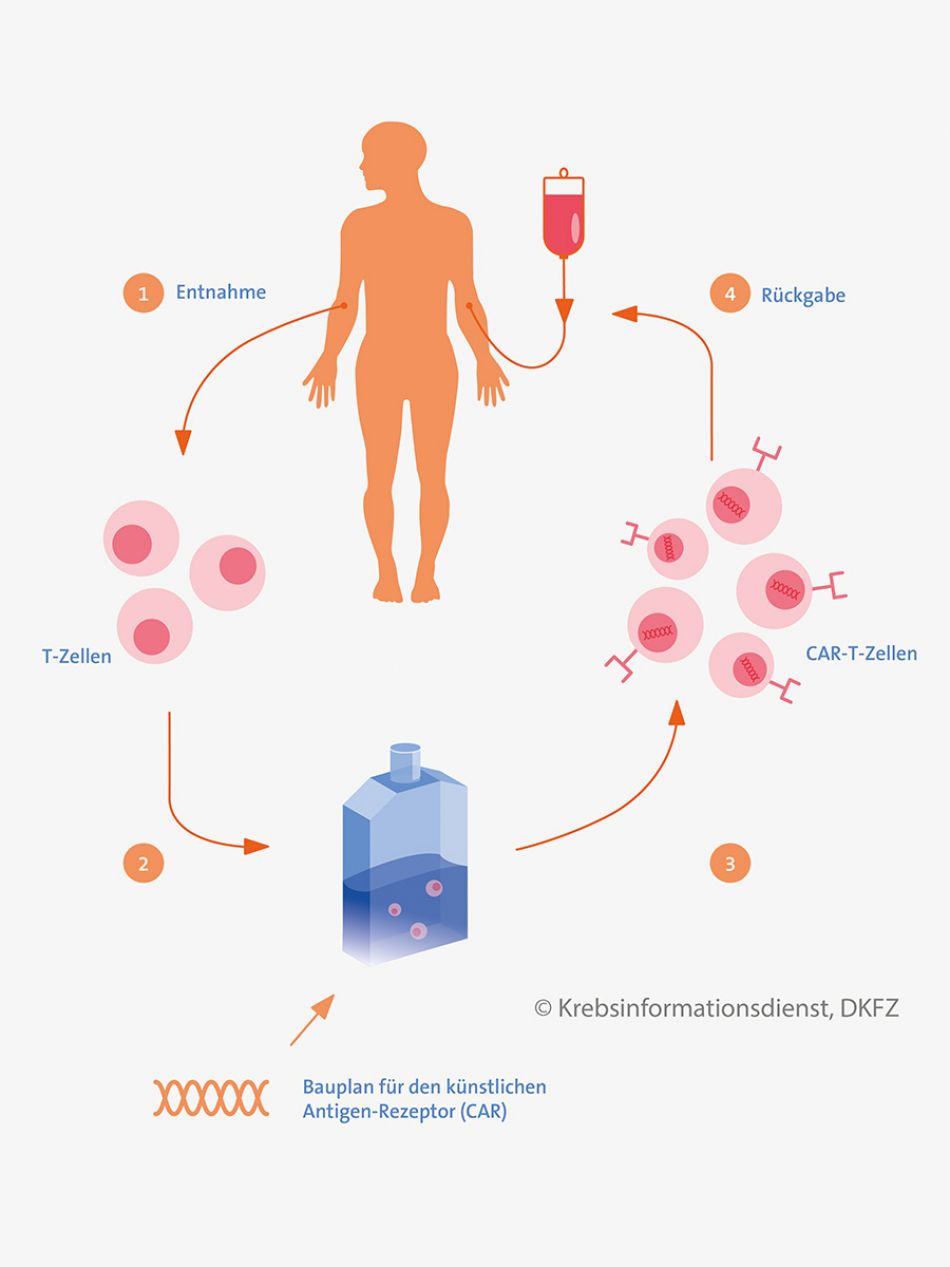 Für die CAR-T-Zell-Therapie werden T-Zellen aus den Blut des Patienten gewonnen, im Labor gentechnisch verändert und dann wieder dem Patienten zurückgegeben.