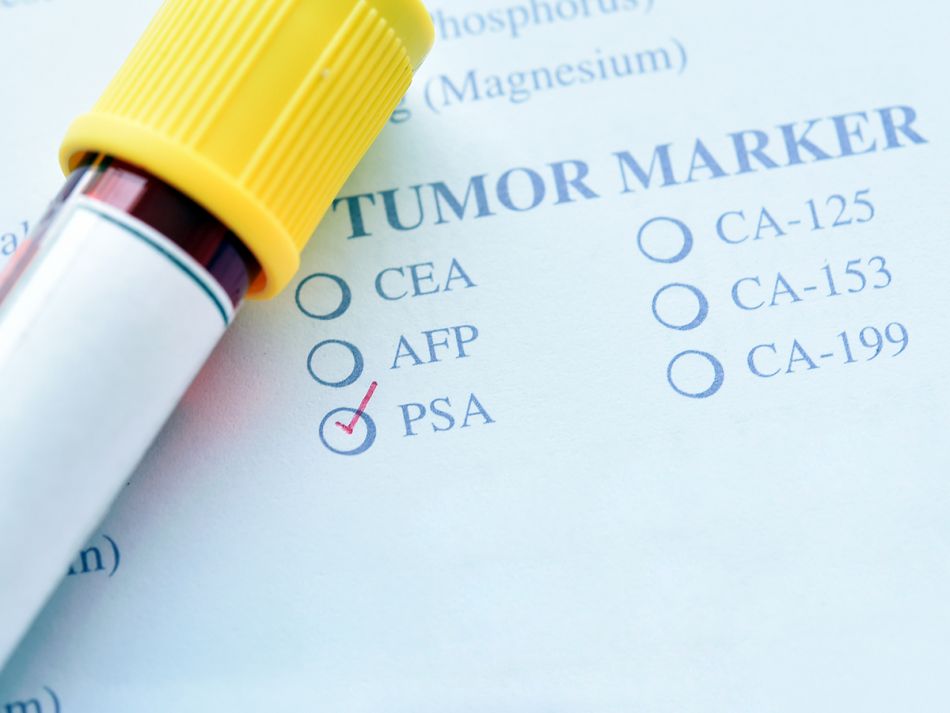 Probenröhrchen liegt auf Papier mit Liste von Tumormarkern. 