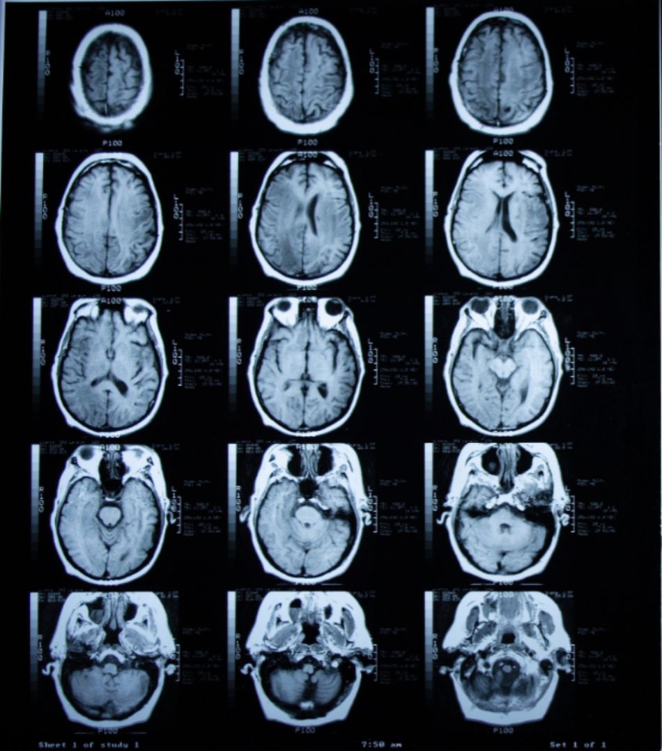 Aufnahme einer Magnetresonanztomographie (MRT) des Gehirns ohne Kontrastmittel.