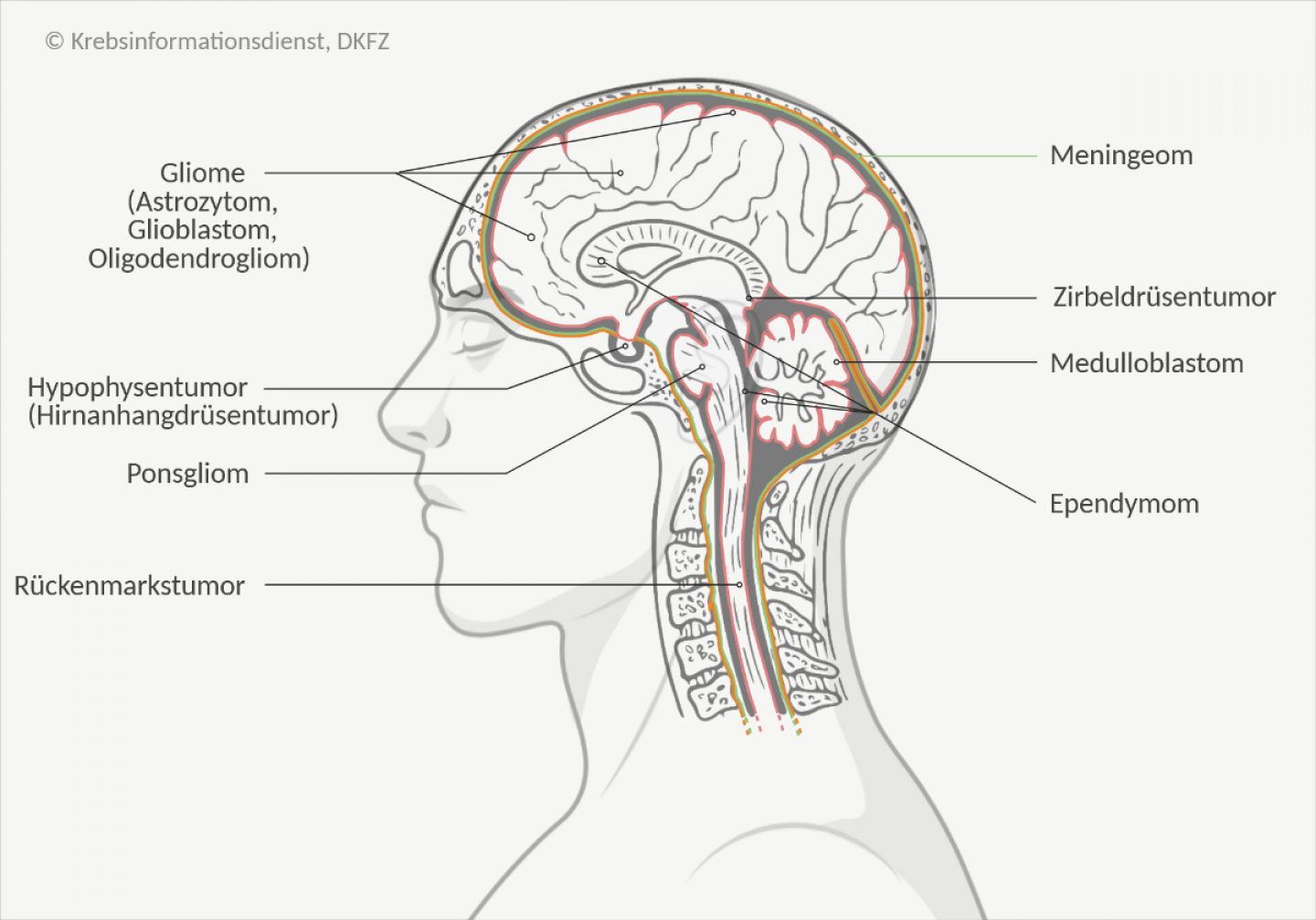 Es gibt verschiedene Arten von Hirntumoren, die in unterschiedlichen Bereichen des Gehirns entstehen können, unter anderem Gliome, Meningeome, Neurinome oder Rückenmarkstumoren.