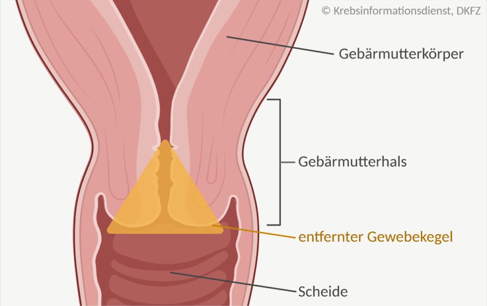 Gewebekegel, der bei einer Konisation ausgeschnitten wird. Er beinhaltet den äußeren Muttermund und einen Teil des Gebärmutterhalses.