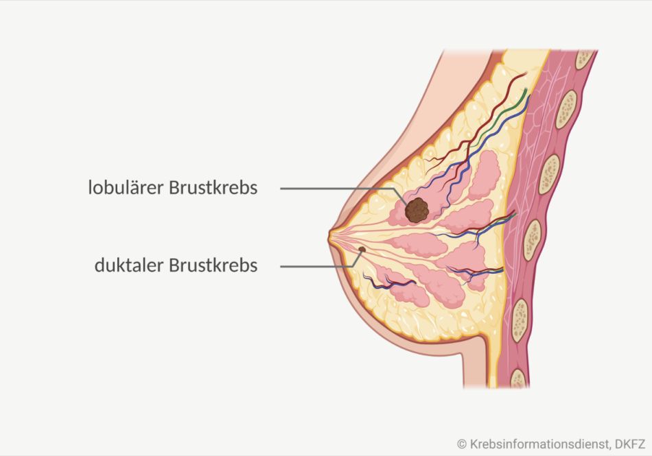 Grafische Darstellung einer weiblichen Brust mit 2 Tumoren, einer sitzt im Drüsenlappen, der andere in/an einem Milchgang.
