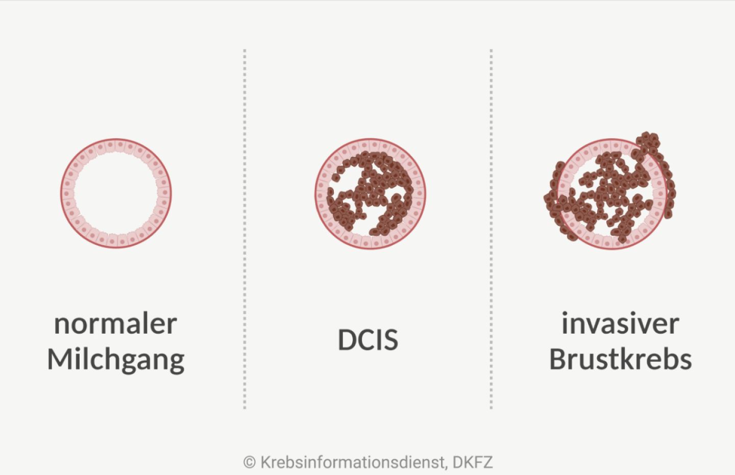 Abgebildet sind Querschnitte eines Milchgangs im Vergleich: normaler Milchgang, DCIS und invasiver Brustkrebs. Bei einem DCIS wachsen die veränderten Zellen nur im Milchgang, bei einem invasiven Brustkrebs durchbrechen sie die Gewebegrenze.