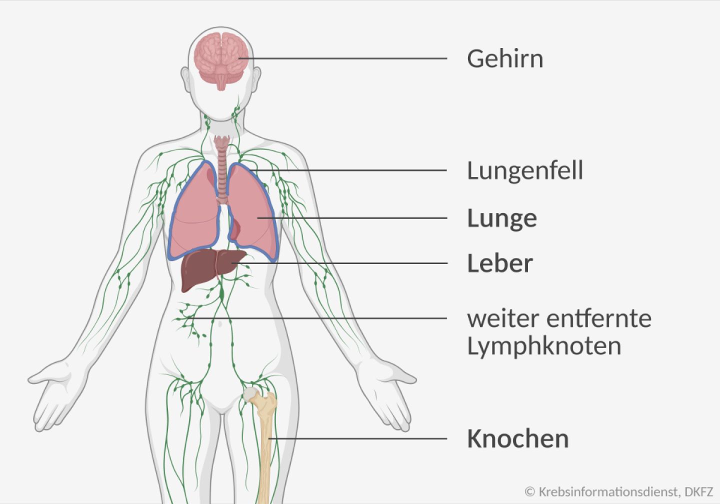 Grafische Darstellung der Gewebe, in die Brustkrebs am häufigsten streut: Knochen, Lunge, Leber, weiter entfernte Lymphknoten, Gehirn und Lungenfell.