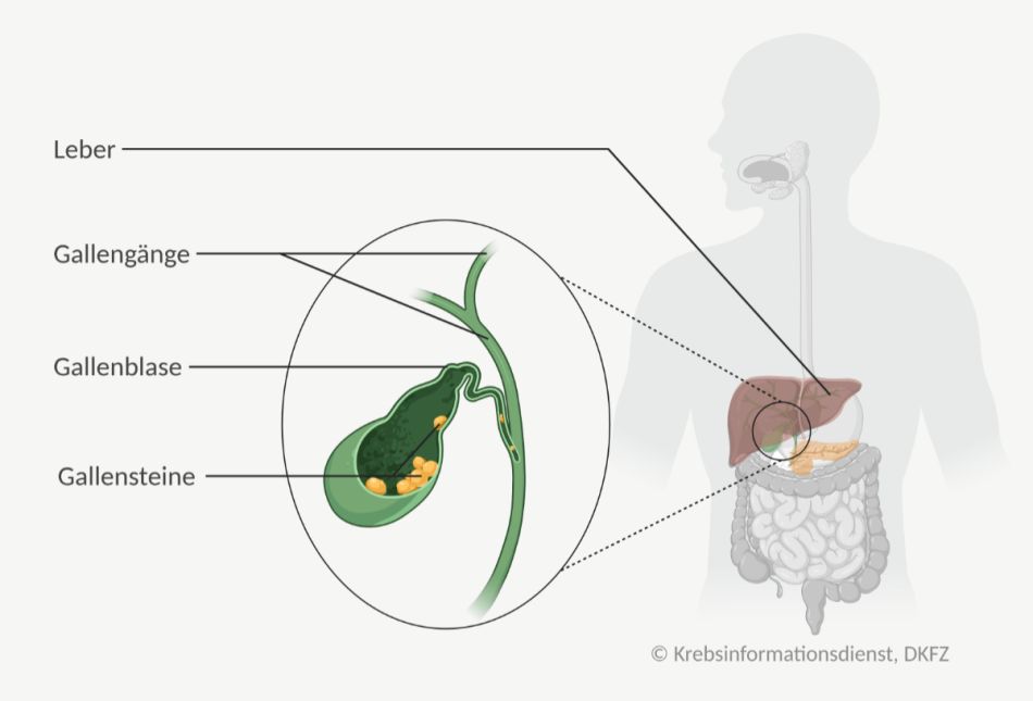 Grafische Darstellung: Lage der Gallenblase im Körper mit vorhandenen Gallensteinen.