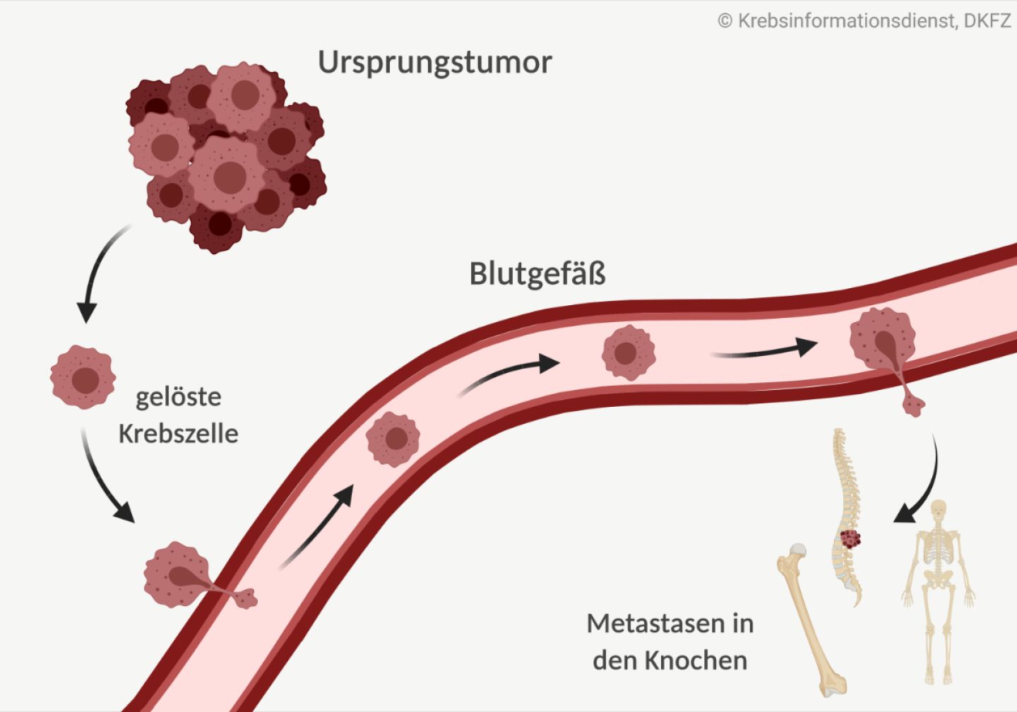 Tumorzellen lösen sich vom Ursprungstumor ab, wandern in die Blutgefäße und von dort in die Knochen.