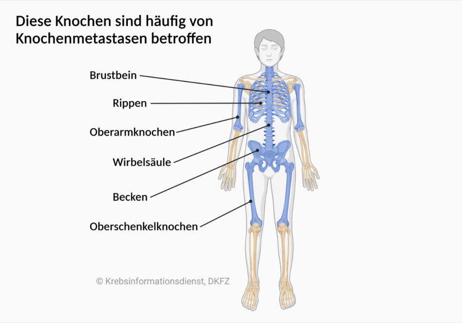 Darstellung des menschlichen Skeletts. Eingefärbt sind: Brustbein, Rippen, Wirbelsäule, Becken sowie Oberarm- und Oberschenkelknochen.