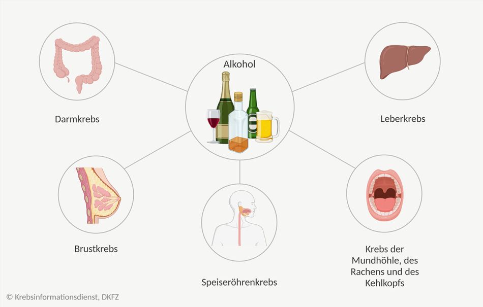 Eine Grafik zeigt die verschiedenen Tumorarten, für die Alkohol als Risikofaktor gilt.
