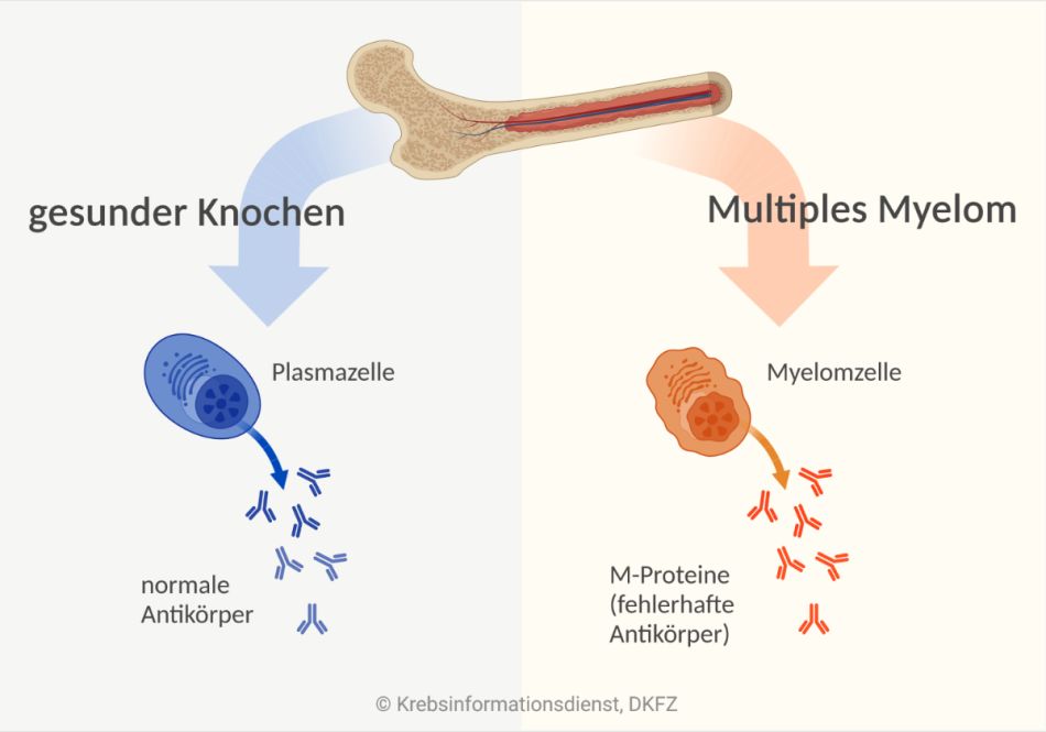 Schematische Darstellung eines Knochen mit Knochenmark, gesunder Plasmazellen und Myelomzellen.