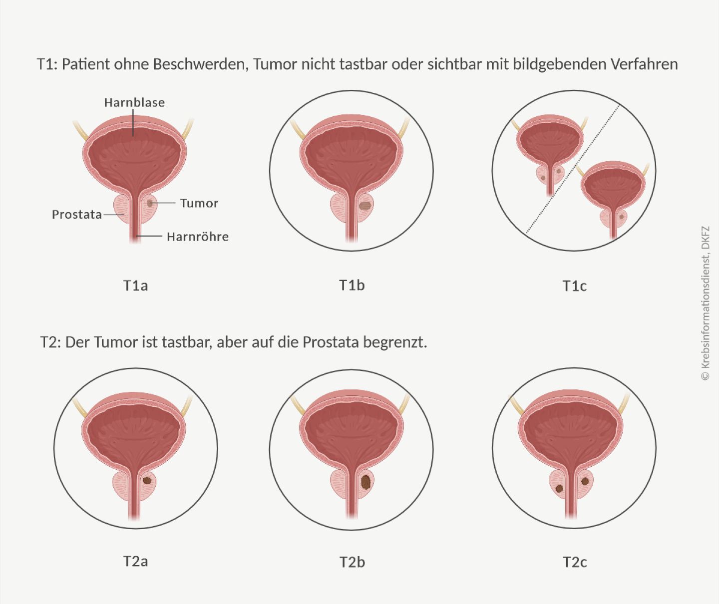 Grafische Darstellung der 6 Tumorstadien bei lokal begrenztem Prostatakrebs.