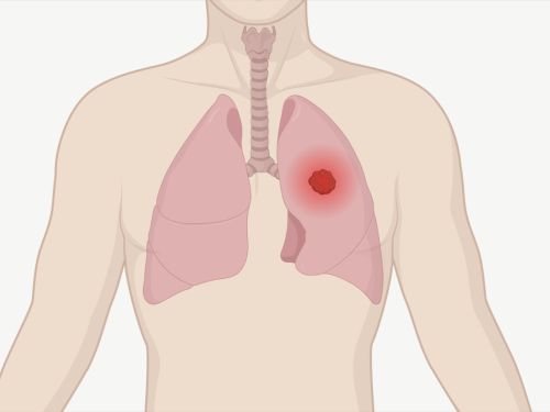 Grafik eines menschlichen Oberkörpers mit Lunge und Luftröhre. Ein Tumor in der Lunge ist als leuchtender Punkt dargestellt.