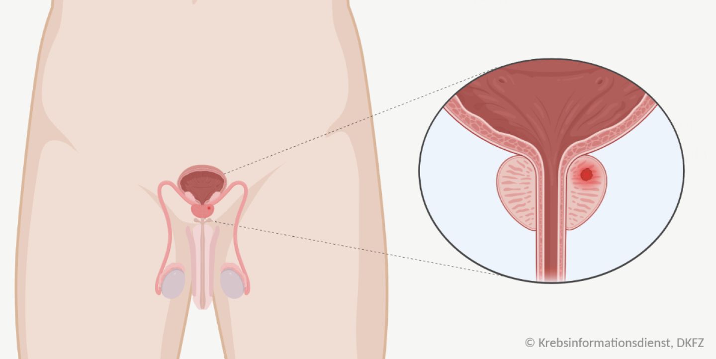 Grafische Darstellung der Lage der Geschlechtsorgane, Harnblase, Harnröhre. In der Prostata befindet sich ein Tumor (rot).