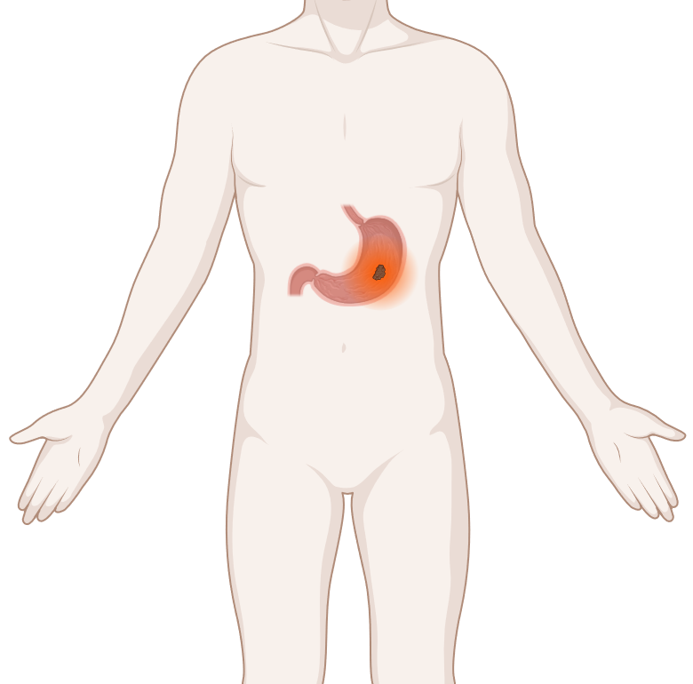 Schematische, anatomische Darstellung einer Bauchspeicheldrüse mit leuchtendem Tumor