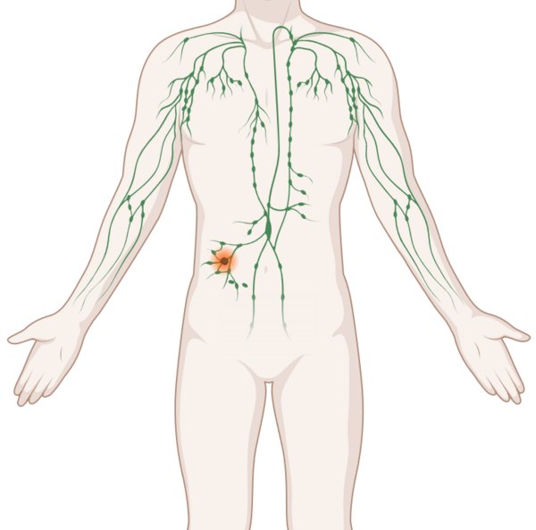 Lymphome, © Krebsinformationsdienst, DKFZ; erstellt mit Biorender.com Schematische, anatomische Darstellung des lymphatischen Systems mit leuchtendem Tumor.