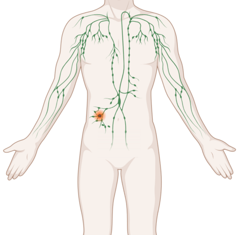 Lymphome, © Krebsinformationsdienst, DKFZ; erstellt mit Biorender.com Schematische, anatomische Darstellung des lymphatischen Systems mit leuchtendem Tumor.
