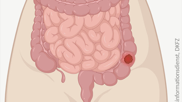 Schematische anatomische Abbildung des Darmtraktes mit leuchtendem Tumor im Dickdarm.