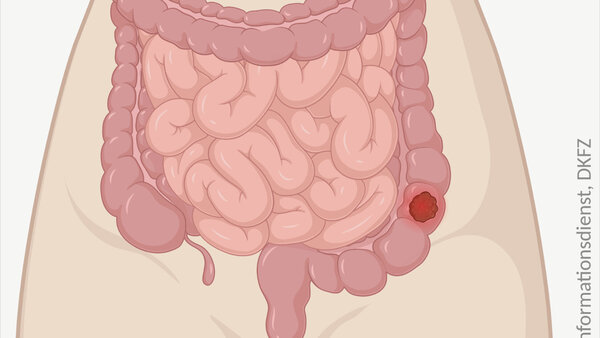 Schematische anatomische Abbildung des Darmtraktes mit leuchtendem Tumor im Dickdarm.