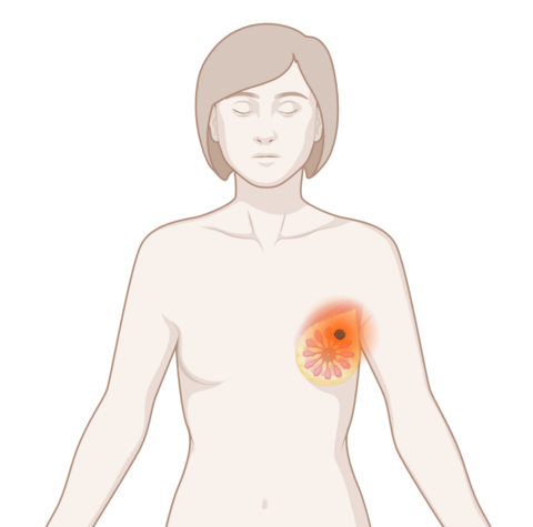 Oberkörper eine Frau mit leuchtendem Tumor an der Brust