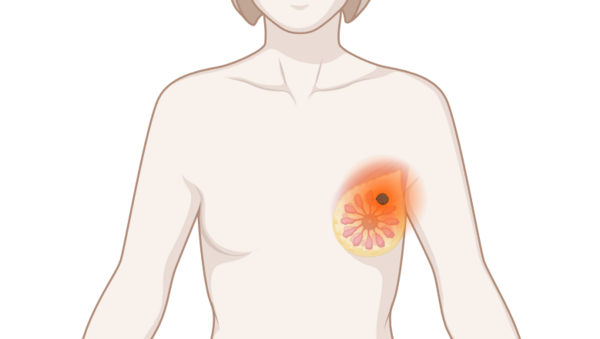 Brust mit Tumor, © Krebsinformationsdienst, DKFZ; erstellt mit Biorender.com Oberkörper eine Frau mit leuchtendem Tumor an der Brust