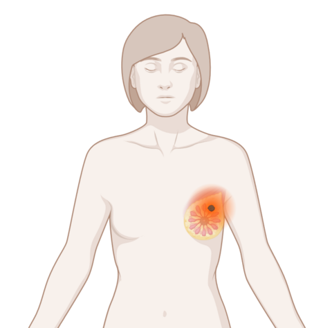 Oberkörper eine Frau mit leuchtendem Tumor an der Brust