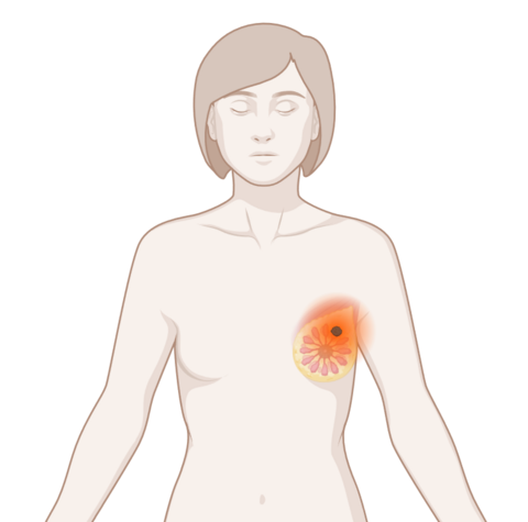Brust mit Tumor, © Krebsinformationsdienst, DKFZ; erstellt mit Biorender.com Oberkörper eine Frau mit leuchtendem Tumor an der Brust