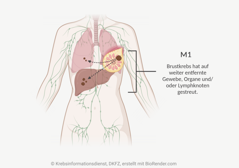 Infografik eines weiblichen Rumpfes mit dem lymphatischen System, einigen inneren Organen, einem Tumor in der linken Brust und Metastasen in der Lunge und der Leber.