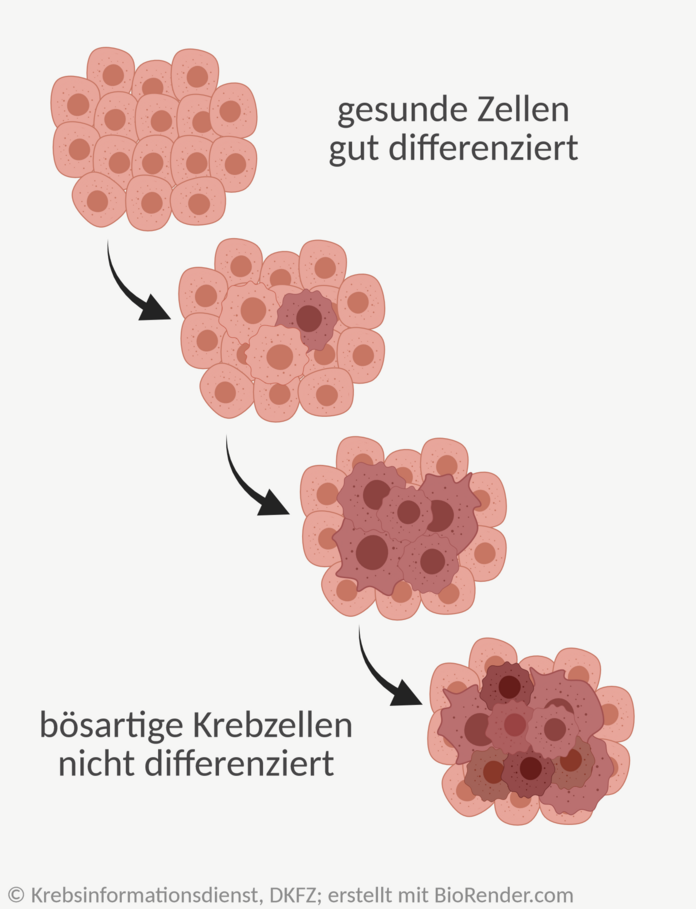 Differenzierungsgrade, © Krebsinformationsdienst, DKFZ; erstellt mit BioRender.com Grafik: Darstellung der Veränderungen von gesunden Zellen zu bösartigen Tumorzellen.