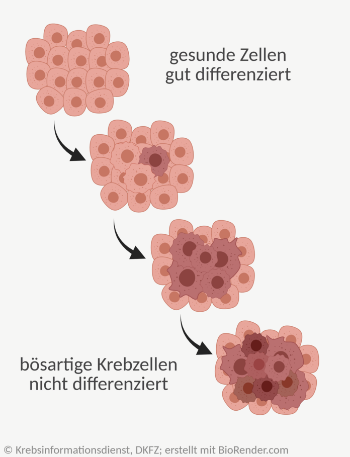 Differenzierungsgrade, © Krebsinformationsdienst, DKFZ; erstellt mit BioRender.com Grafik: Darstellung der Veränderungen von gesunden Zellen zu bösartigen Tumorzellen.
