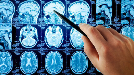 MRT-Aufnahmen des Gehirns, Hand mit Stift zeigt auf einen der Schnitte