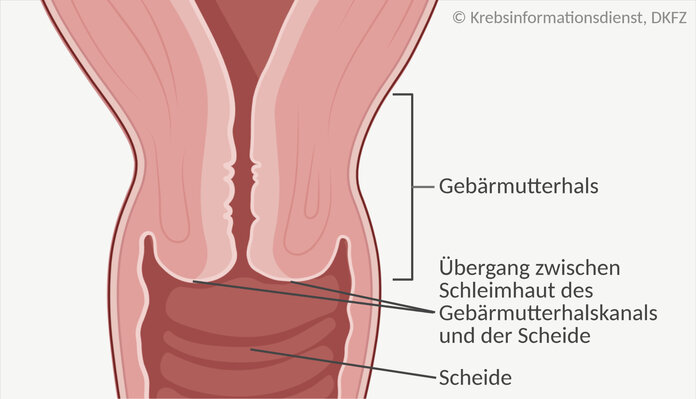 Schematische Darstellung des Übergangsbereichs der Schleimhaut von Scheide und Gebärmutterhalskanal.