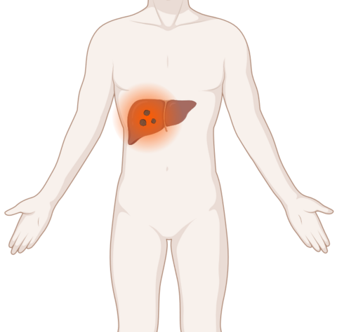 Schematische, anatomische Darstellung des Körpers mit mehreren leuchtenden Tumoren (Metastasen) in der Leber.