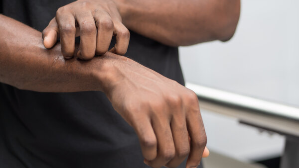 Eine Hand kratzt die Haut am Unterarm wegen Hautjucken