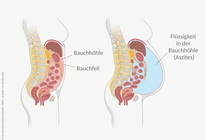 Grafische Darstellung des Bauchraums. Bei einem Aszites sammelt sich so viel Flüssigkeit in der Bauchhöhle, dass sich der Bauch vorwölbt.