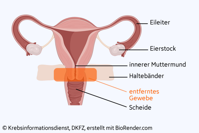 Trachelektomie, © Krebsinformationsdienst, DKFZ, erstellt mit BioRender.com Anatomische Darstellung der Gebärmutter mit den Geweben, die bei der Trachelektomie herausoperiert werden.
