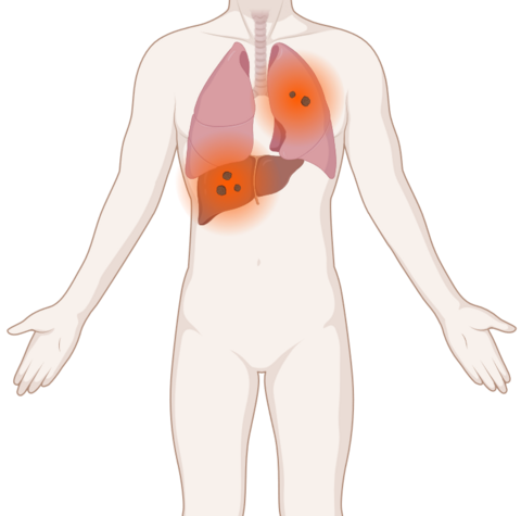 cup-snydrom, © Krebsinformationsdienst, DKFZ; erstellt mit BioRender.com Schematische, anatomische Darstellung der Lunge und Leber mit leuchtenden Tumoren