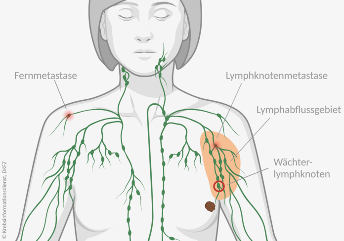 Anatomische Darstellung eines weiblichen Oberkörpers mit einem Tumor in der linken Brust. Das Lymphabflussgebiet ist markiert, darin ist eine Lymphknotenmetastase eingezeichnet. In der entfernten, rechten Schulter ist eine Fernmetastase in einem Lymphknoten dargestellt.
