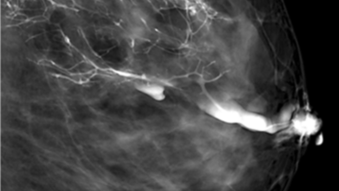Schwarz-weißes Röntgenbild einer weiblichen Brust mit weißlich sichtbaren Milchgängen.