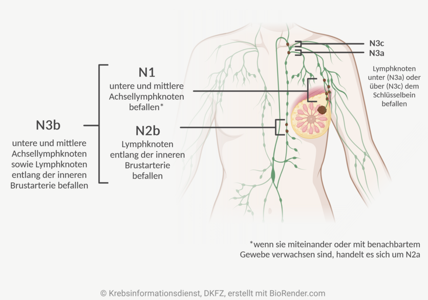 Infografik eines weiblichen Oberkörpers mit dem lymphatischen System und einem Tumor in der linken Brust. In einigen umliegenden Lymphknoten des Tumors befinden sich Metastasen.