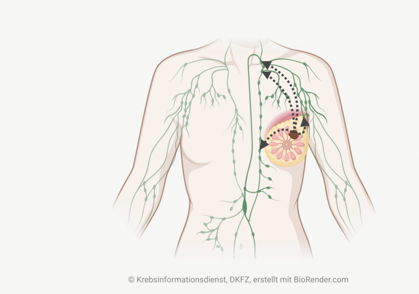 Infografik eines weiblichen Oberkörpers mit dem lymphatischen System und einem Tumor in der linken Brust. Pfeile deuten an, wie Krebszellen in umliegende Lymphknoten des Tumors wandern.