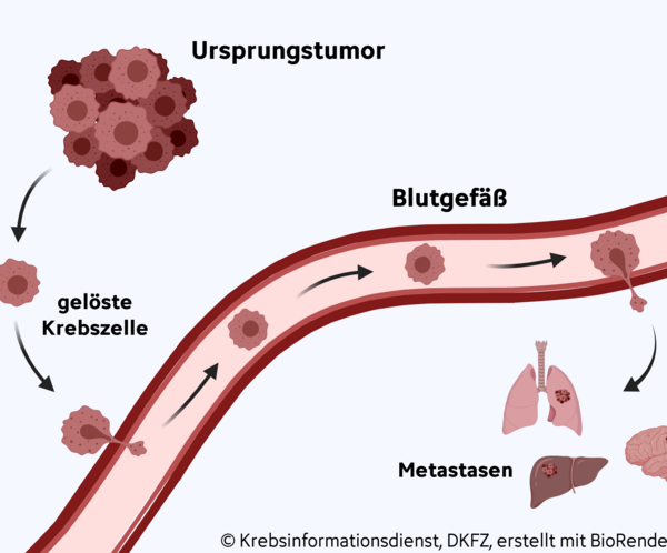 metastasenbildung, © Krebsinformationsdienst, DKFZ; erstellt mit BioRender.com Graphische Darstellung zur Entstehung von Metastasen: Vom Ursprungstumor lösen sich Krebszellen ab und gelangen über die Blutbahn in andere Organe. Dort bilden sie Metastasen.