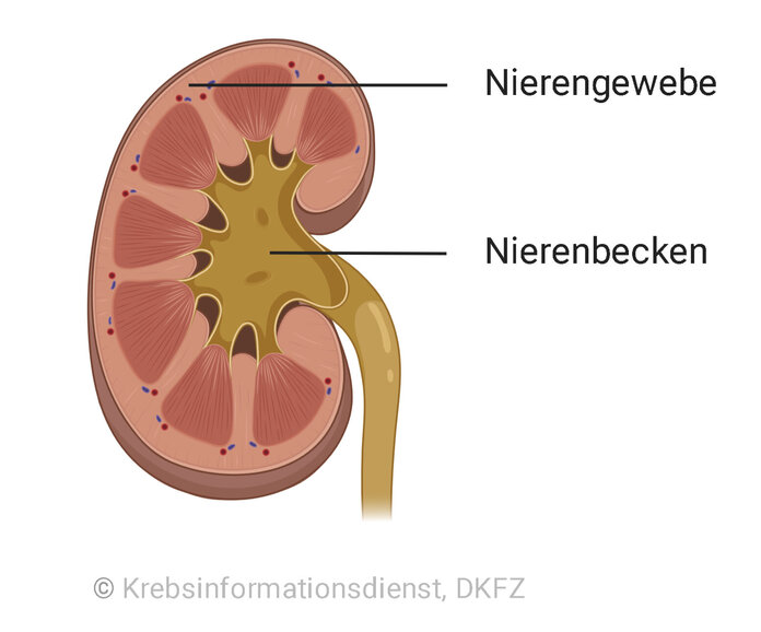 Anatomisch unterteilt sich die Niere in Nierenbecken und Nierengewebe. Das Nierenzellkarzinom geht vom Nierengewebe aus.