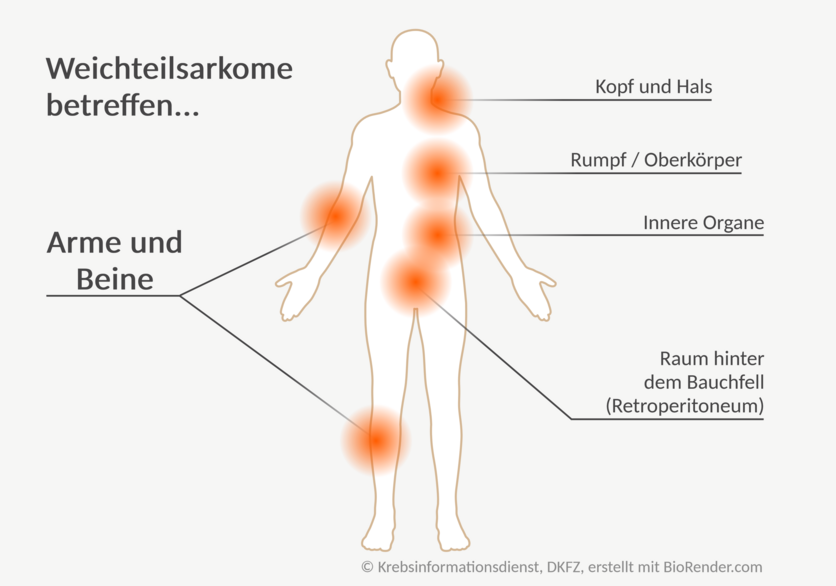 Bei einer menschlichen Silhouette sind mehrere Körperbereiche markiert: Arme und Beine, Kopf und Hals, Rumpf, Innere Organe, Raum hinter dem Bauchfell.